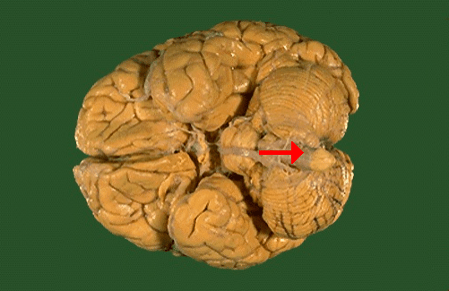 <p>Most posterior; composed mainly of tracts; reticular formation plays role in arousal.</p>
