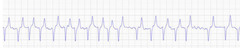 <p>Describe this ECG during exercise</p>