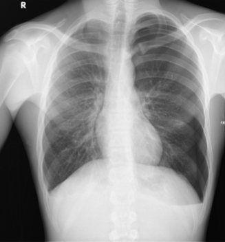 <p>what is the abnormality is noted on the patient’s left side in this image?</p>