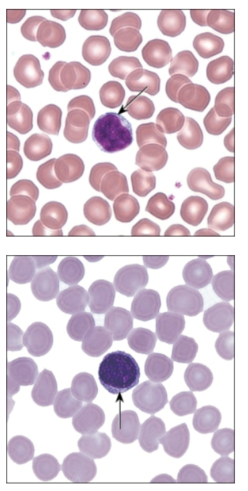 <p>Agranulocytes—lymphocytes</p><ul><li><p>20–25% of total blood leukocytes</p></li><li><p>Slightly larger than RBCs</p></li><li><p>Round nucleus that fills most of cell</p><ul><li><p>Tiny ring/crescent of cytoplasm visible</p></li></ul></li><li><p>Following development enter lymph and establish clones</p></li><li><p>Respond to antigens</p></li></ul><p></p>