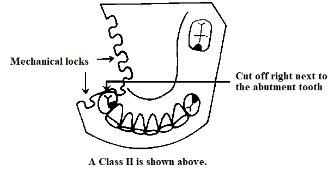 <p>The distal extension portions of the master cast are cut off with a coarse saw blade and key-shaped undercuts are made. Why?</p>