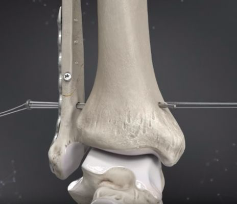 <p></p><ul><li><p>There are two "buttons" and a "tight rope" to hold the tibia and fibula together</p></li><li><p>Allows for a better relationship between the tibia and fibula as well as the mortise</p><ul><li><p>Not as "rigid" and allows for more ROM</p></li></ul></li></ul><p></p>