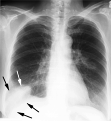 <p>right lower lobe</p>