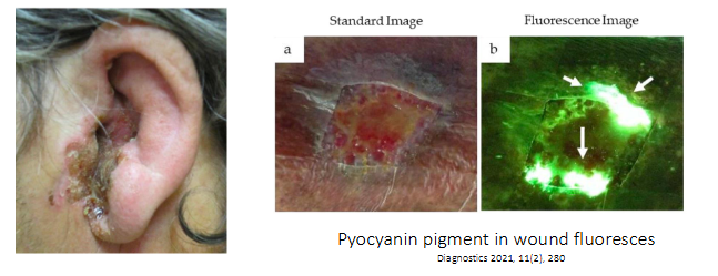 <p>- Cystic fibrosis - chronic lung infection occurs in over 60% of adults with CF - linked to higher mortality</p><p>- Burn wound infections - a blue-green purulent discharge may be found</p><p>- Diabetes - malignant otitis externa</p><p>.</p><p>OFTEN HEALTHCARE ASSOCIATED:</p><p>- Organ transplant recipients or ICU patients - pneumonia, urinary tract infections, bacteraemia</p><p>- Invasive diseases, e.g indwelling catheters or endotracheal tubes - at risk due to ability to fom biofilms</p>