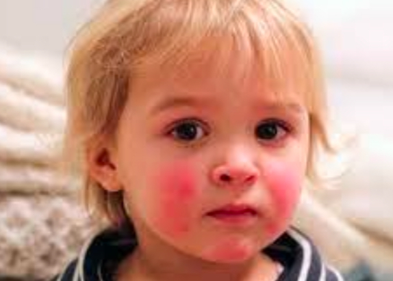<p>what might children with pre-existing anemias develop with <strong>fifth disease</strong>?</p>