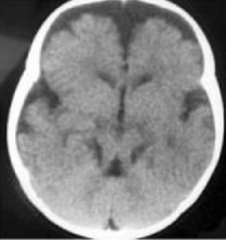<p>Brain finding which may be suspected on prenatal ultrasound & confirmed by MRI. Occurs due to several related brain changes: abnormally deep interpeduncular fossa; elongated, thick, and maloriented superior cerebellar peduncles; and absent or hypoplastic cerebellar vermis. Highly associated with Joubert but can rarely have other causes.</p>
