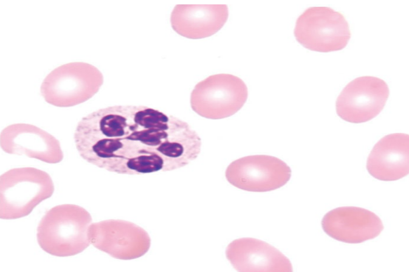 <p>what is hypersegmentation?</p>