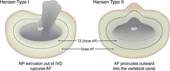 <p>Hansen type II</p>