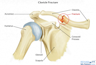 <p>Clavicular Fracture</p>