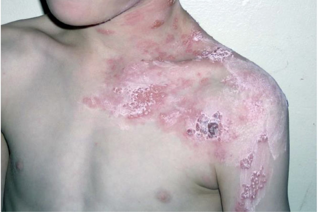 <p>what is this lesion associated with</p>