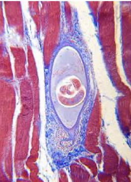 <ul><li><p>encysted larva in skeletal muscle tissue </p></li><li><p>causes Trichinellosis (Trichinosis)</p></li></ul><p></p>