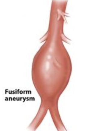 <p>spindle-shaped aneurysm</p>