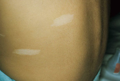 <p>hypomelanotic areas of the skin present in 90% of patients having tuberous sclerosis</p>
