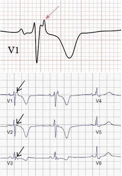 <p>Most prominently seen in the right precordial leads (V1 to V3), which directly face the right ventricle.</p><p>Arrhythmogenic Right Ventricular Cardiomyopathy (ARVC)</p><ul><li><p><span>genetic heart disorder where the right ventricular muscle wall breaks down over time.</span></p></li><li><p><span>It is a well-known cause of dangerous ventricular arrhythmias and sudden cardiac death in young people and athletes.</span></p></li></ul><p></p>