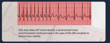 <ul><li><p>syncronized shock: defibrillator is set to synchronize with the EKG on a cardiac monitor so that the elecctrical implse dischargers during ventricular depolarization (QRS comple)</p></li><li><p>indications: SVT, A-fib, A-flutter, or unstable VT with a pulse</p></li></ul><p></p>