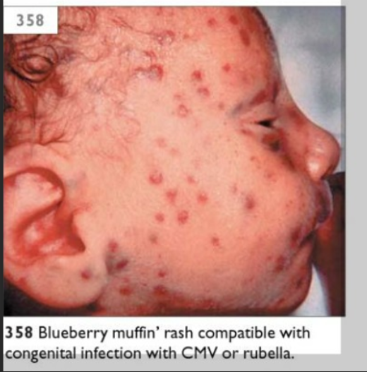 <ol><li><p><span style="color: rgb(238, 123, 123);"><strong>neonatal gonorrhea</strong></span></p></li></ol><ul><li><p>severe: ophthalmia neonatorum and sepsis</p></li></ul><ol start="2"><li><p><span style="color: rgb(229, 160, 34);"><strong>toxoplasmosis</strong></span></p></li></ol><p></p><ol start="3"><li><p><span style="color: rgb(229, 160, 34);"><strong>cytomegalovirus</strong></span></p></li></ol><p></p><ol start="4"><li><p><span style="color: rgb(174, 208, 19);"><strong>HSV</strong></span></p></li></ol><ul><li><p><span style="color: rgb(174, 208, 19);"><strong>vesicular </strong></span>lesions</p></li></ul><ol start="5"><li><p><span style="color: rgb(32, 188, 111);"><strong>syphilis</strong></span></p></li></ol><ul><li><p><span style="color: rgb(6, 10, 8);">lesions on</span><span style="color: rgb(32, 188, 111);"> <strong>palms and soles</strong> </span></p></li></ul><ol start="6"><li><p><span style="color: rgb(80, 133, 226);"><strong>zika virus</strong></span></p></li></ol><ul><li><p><span style="color: rgb(80, 133, 226);">microcephaly</span><span style="color: rgb(68, 153, 216);"> </span>(has brain damage)</p></li></ul><ol start="7"><li><p><span style="color: rgb(199, 73, 224);"><strong>congenital rubella syndrome</strong></span></p></li></ol><ul><li><p><span style="color: rgb(199, 73, 224);">blueberry muffin</span><span style="color: rgb(2, 0, 2);"> rash</span></p></li></ul><ol start="8"><li><p><span style="color: rgb(241, 86, 119);"><strong>varicella</strong></span></p></li></ol><ul><li><p>skin lesions</p></li></ul><ol start="9"><li><p><span style="color: rgb(76, 121, 190);"><strong>HPV</strong></span></p></li></ol><ul><li><p><span style="color: rgb(76, 121, 190);"><strong>Hydrops fetalis</strong> </span></p><ul><li><p>fluid builds up in 2+ fetal compartments</p></li></ul></li></ul><p></p><ol start="10"><li><p><span style="color: rgb(52, 142, 56);"><strong>Sars-CoV-2</strong></span></p></li></ol><ul><li><p>resp. problems</p></li><li><p>feeding intolerance</p></li></ul><p></p>