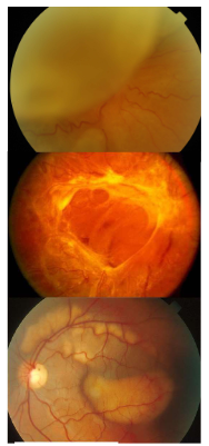 <ul><li><p>Rhegmatogenous Retinal Detachment (RRD)</p><ul><li><p>Cause: retinal break</p></li></ul></li><li><p>Tractional (TRD, retina pulled away by contracting vitreoretinal membranes eg ERM)</p><ul><li><p>Causes: proliferative DR, retinopathy of prematurity, toxocariasis, trauma, previous giant retinal tear</p></li></ul></li><li><p>Exudative (fluid derived from the choriocapillaries gains access to subretinal space)</p><ul><li><p>Causes: neoplastic choroidal lesions, inflammatory disease, optic pit, choroidal coloboma, vascular disorders, nanophthalmos</p></li></ul></li></ul><p></p>