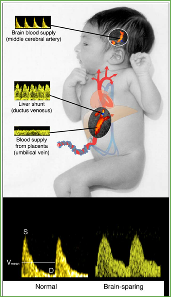 <p>brain sparing effect</p>