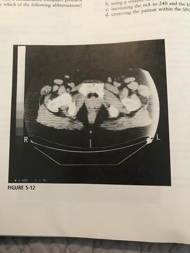 <p>The image in the figure was produced using: large (FULL) SFOV; max DFOV (48cm); 200mA; 120 kVp; soft tissue algorithm. Which technical adjustment would serve to reduce the artifact present?</p><p>A) switching to a detail or bone algorithm</p><p>B) using a smaller SFOV<br>C) increasing the mA to 240 and the kVp to 140</p><p>D) centering the patient within the SFOV</p>