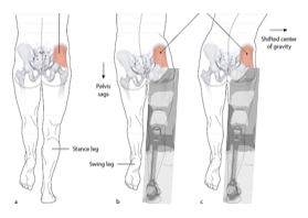 <p>Short residual limb </p><p>Weak hip abductors - as this deviation takes weight off of the gluteus medius </p>