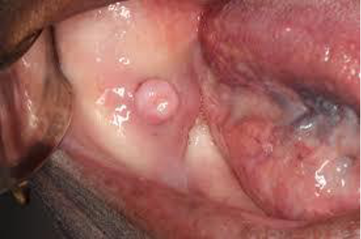<p>CASE: A 6-mm pedunculated oral nodule is strongly suspected to be benign and can be removed completely with little morbidity. Which biopsy type is most appropriate?</p>