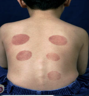<p>Skin discoloration caused by inflammation of small blood vessels (vasculitis). (5 mm-1 cm)</p>