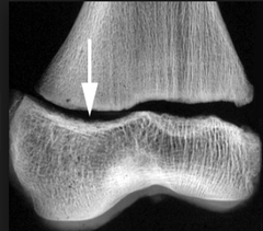 <p>define a salter harris I fracture</p>