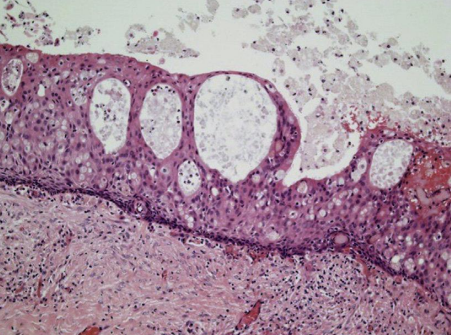 <p>A cyst of jaw</p>