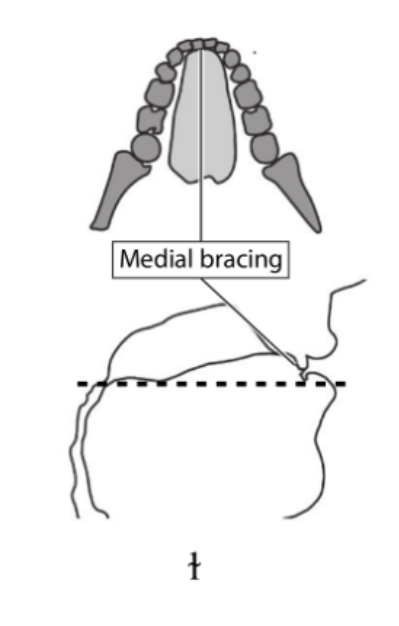 <p>essential for sounds that direct airflow laterally along sides of tongue (ex. lateral fricatives + lateral approximants)</p><ul><li><p>occurs when tongue makes contact with roof of mouth along its center</p></li><li><p>provides mechanism for achieving a tight central seal when allowing air to escape laterally</p></li></ul><p></p>