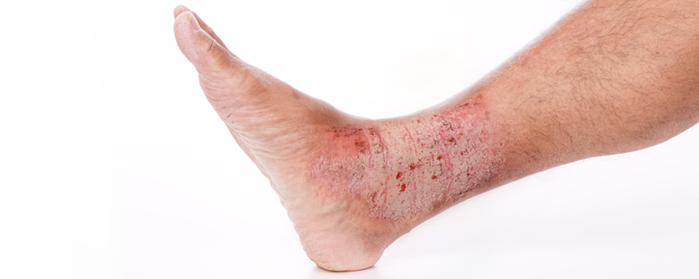 <p>What causes lichen simplex chronicus?</p>