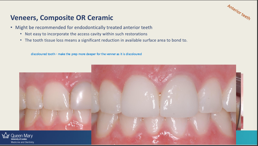 <ul><li><p>Not easy to incorporate the access cavity within such restorations</p></li><li><p>The tooth tissue loss means a significant reduction in available surface area to bond </p></li></ul><p></p>