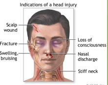 <ul><li><p><span style="font-family: "Trebuchet MS";">A closed head injury occurs when a person receives a traumatic blow to the head without a facture or displacement to the skull.</span></p></li><li><p style="text-align: left;"><span style="font-family: "Trebuchet MS";">Closed head injuries are quite dangerous because secondary swelling occurs within the brain, either from edema or bleeding. Resulting compression causes further injury (secondary injuries).</span></p><ul><li><p><span style="font-family: "Trebuchet MS";">Brain swelling may manifest by liquid or brain tissue swelling through any available openings, including the eye sockets.</span></p><ul><li><p><span style="font-family: "Trebuchet MS";">This affects the cranial nerves controlling the eye muscles with resultant eye muscle impairment. </span></p></li><li><p><span>If Cranial Nerve III is compressed the pupil will appear dilated.</span></p></li><li><p><span>Medical personnel can initially assess intracranial pressure through pupil size.</span></p><ul><li><p><span>ER personnel sometimes term this condition as a “blown pupil” (herniation or cranial compression).</span></p></li></ul></li></ul></li></ul></li></ul><p></p>