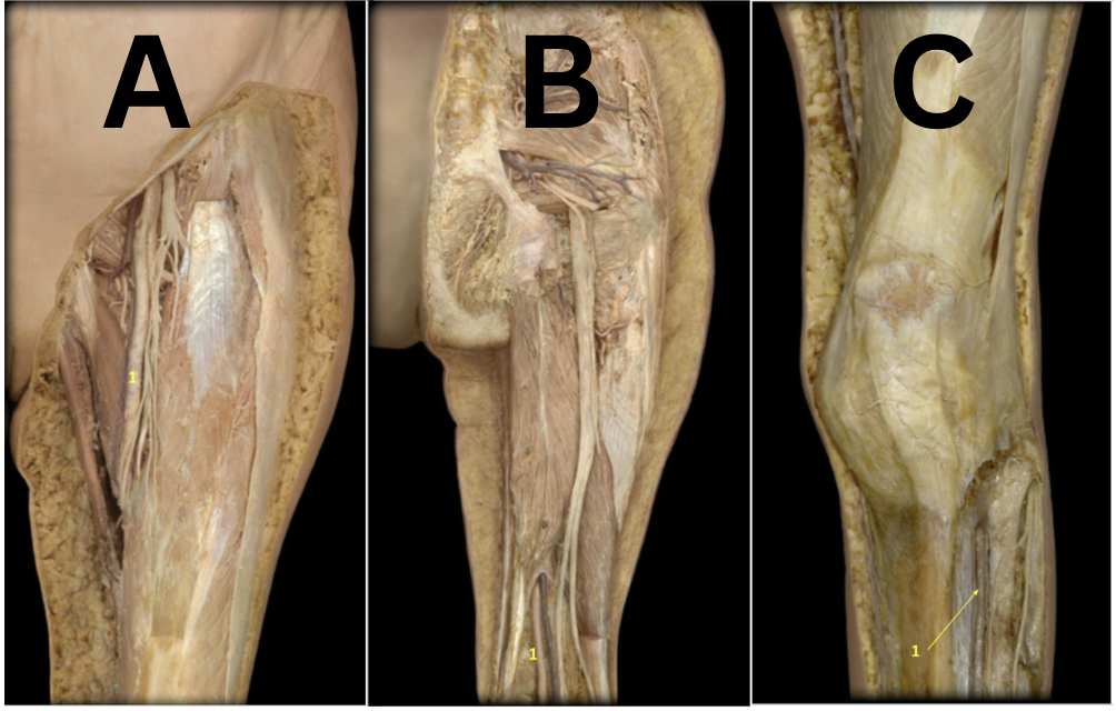 <p>A: Left femoral artery</p><p>B: Left popliteal artery</p><p>C: Left anterior tibial artery</p>