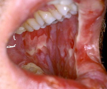 <p>begins a few day to weeks after chemo begins; ulcerations and sloughing of the epithelium; common on the lips, tongue, and gingiva; resolves slowly within weeks after TX</p>