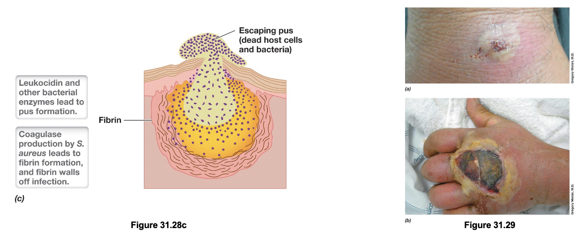 <ul><li><p>Pyogenic infections are pus-forming infections caused by opportunistic pathogens such as <em>Staph. aureus, Staph. epidermidis, </em>and<em> Strep. pyogenes</em> that enter the body through skin cuts </p></li><li><p>Once inside, these bacteria use virulence factors like coagulase to induce fibrin clot formation, and produce toxins such as hemolysins and leukocidins to destroy RBCs and WBCs</p></li><li><p>This leads to the accumulation of dead cells, bacteria, and cellular debris which forms the pus</p></li><li><p>As infection progresses, pressure builds within the localized abscess until it may rupture, facilitating further spread of the pathogen</p></li></ul><p></p>