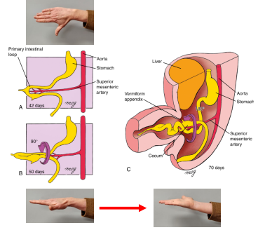 <ol><li><p>A cecal primordium develops distinguishing the future ileum from future colon </p></li><li><p>Developing ileum elongates more rapidly than the abdominal cavity</p></li><li><p>Midgut develops the primary intestinal loop </p></li><li><p>Cranial arm of loop becomes most of the ileum </p></li><li><p>Caudal arm of loop becomes ascending and transverse colon</p></li><li><p>Apex of the loop is attached to the umbilicus by the vitelline duct &amp; superior mesenteric artery = axis of the loop </p></li><li><p>Week 6 – abdominal cavity becomes too small to contain all of the intestinal loops (partly due to rapid expansion of the liver) </p></li><li><p>Pressure from rapidly developing abdominal organs, especially liver, forces the intestinal loop into the extraembryonic cavity of the umbilical cord = midgut herniation </p></li><li><p>As the primary intestinal loop herniates it rotates around the axis of the superior mesenteric artery by 90 degrees </p></li><li><p>Cranial arm of loop moves to embryo’s right side &amp; caudal arm moves left This first rotation is complete by early week 8</p></li><li><p>The gut continues to differentiate: lengthening jejunum and ileum form folds called jejunal-ileal loops and cecum expands and develops the worm-like vermiform appendix </p></li><li><p>In week 10 the midgut herniation rapidly returns to the abdomen due to increased size of abdominal cavity relative to the other abdominal organs where growth has slowed </p></li><li><p>As the intestinal loop returns to the abdomen, it rotates by 180 degrees </p></li><li><p>Cecum ends up just inferior to the liver near the right iliac crest</p></li></ol><p></p>