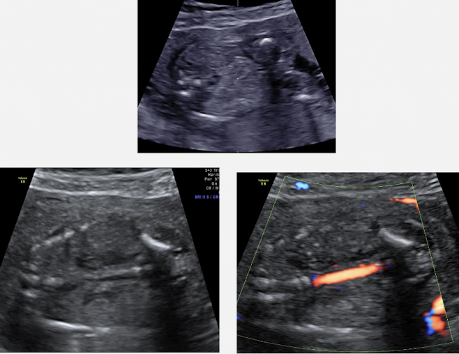 <ul><li><p>absent kidneys</p></li><li><p>adrenals: flattened within renal fossa</p></li><li><p>absent renal artery branches</p></li><li><p>bladder: not visualized; no urine (observe for 1 hours)</p></li><li><p>AFI: oligo- or anhydramnios </p></li></ul><p></p>