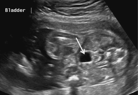 <ul><li><p>distended bladder should be seen by 13wks</p></li><li><p><span style="color: red;">empties and fills at least once every 30 minutes</span></p></li><li><p>if not identified on exam; exam must be repeated within 24 hours</p></li><li><p>empty bladder is an indication of abnormality</p></li><li><p>SONO:</p><ul><li><p><span style="color: red;">anechoic (fluid-filled)</span></p></li><li><p>document in LONG and TRV<br></p></li></ul></li></ul><p></p>