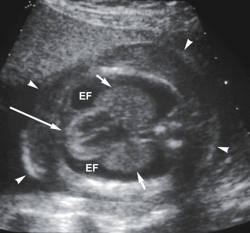<p>Anechoic fluid surrounding the fetal lung(s)—“bat-wing” sign</p><p>Other signs of hydrops may be present</p>