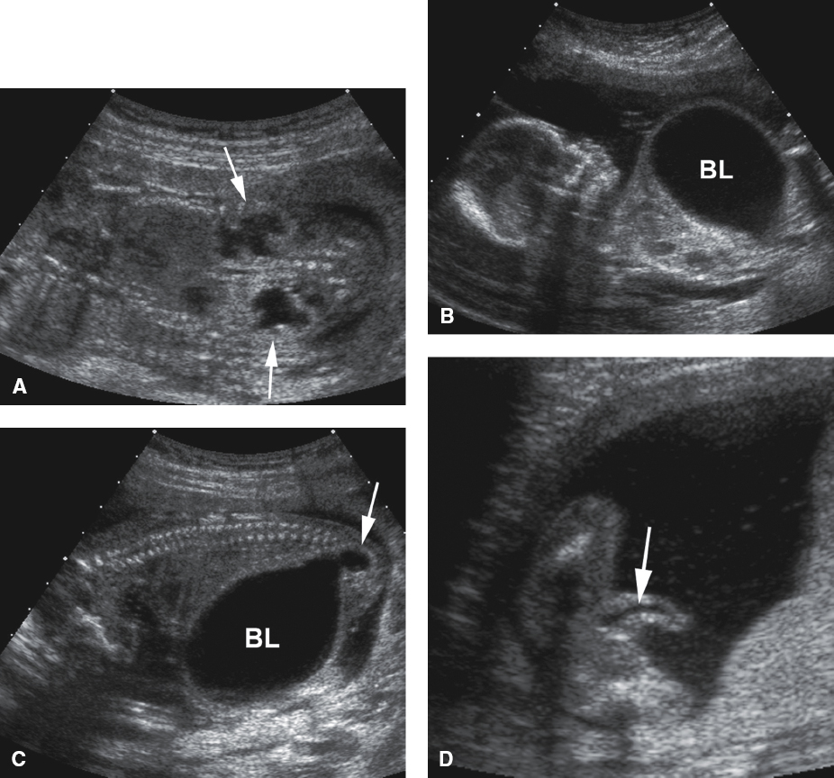 <p>Dilated bladder and, possibly, urethra (“keyhole” sign)</p><p>Absent abdominal musculature</p><p>Undescended testis</p><p>Urinary tract abnormalities (megacystis and hydronephrosis)</p>
