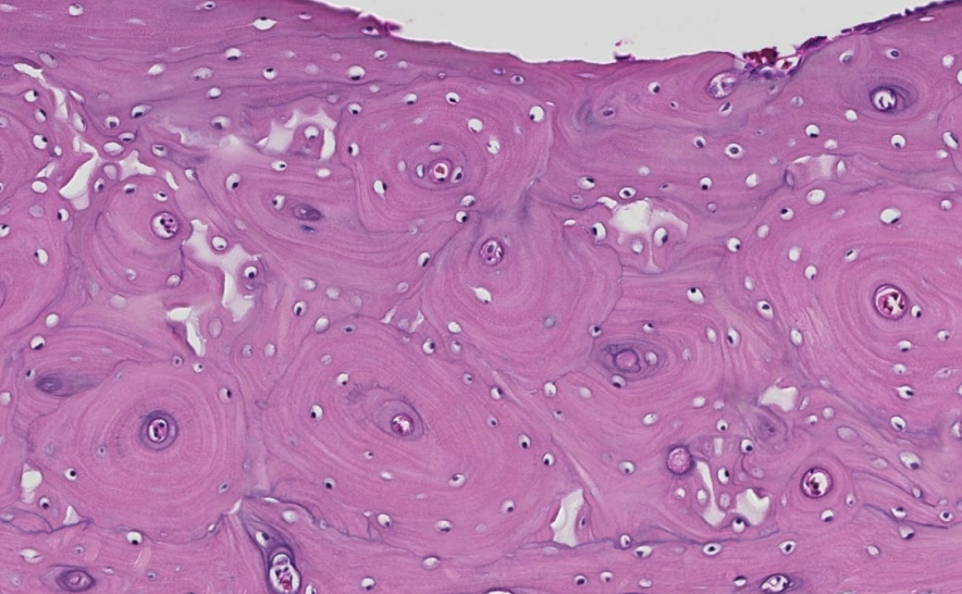 <p>Lamellar bone is mature bone formed slowly by remodeling a woven-bone precursor. It has Haversian systems/osteons composed of organized layers of lamellae.</p>