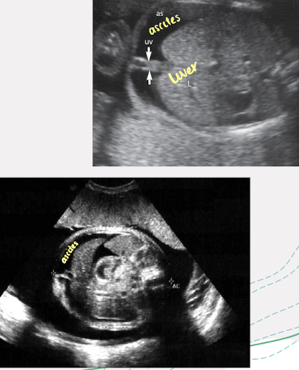 <ul><li><p>fluid collects between 2 leaves of unfused omentum → <span style="color: red;">cyst-like appearance in abdomen</span></p></li><li><p>ascitic fluid may be echogenic</p></li></ul><p></p>