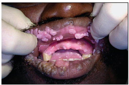 <p>1.what is this lesion?</p><p>2. how to treat/ manage it?</p><p>3. classification of oral lesion in HIV?</p>