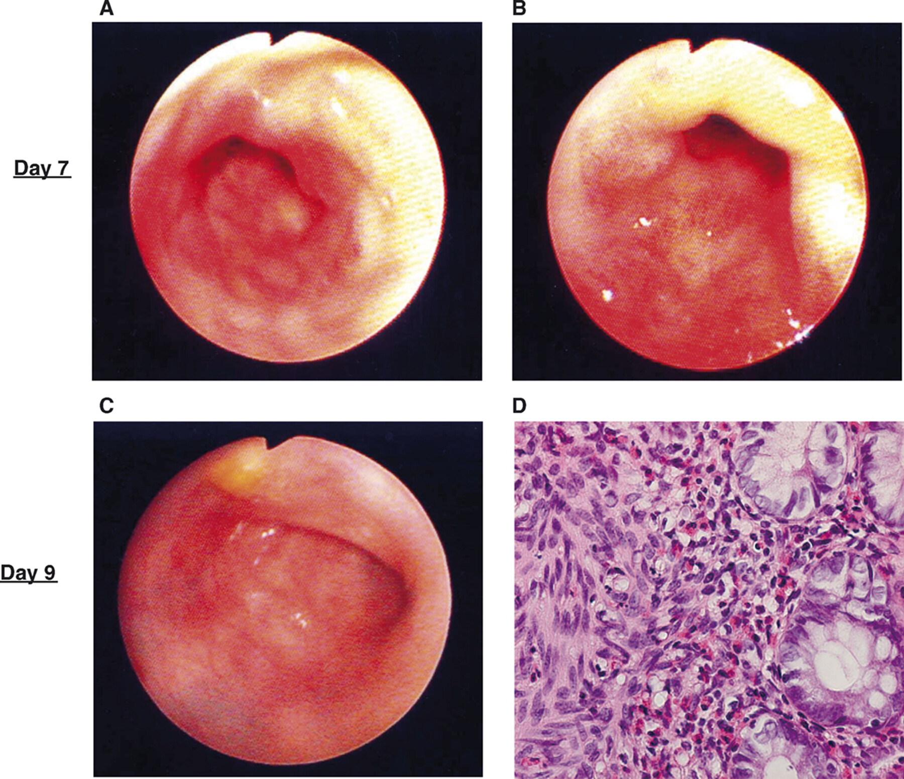 <p>a type of inflammatory bowel disease characterized by an elevated number of eosinophils in the intestinal lining, often manifesting as diarrhea, abdominal pain, and poor growth in infants and children. </p>
