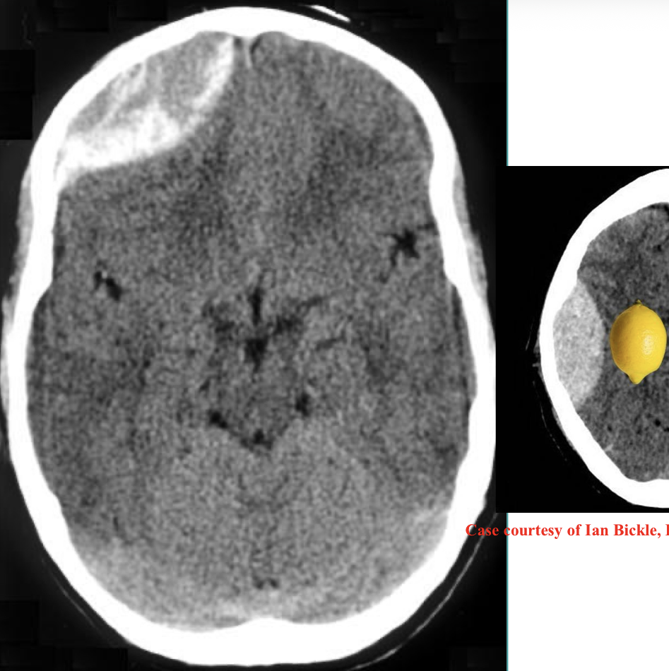 <p>What type of hematoma is found on this x-ray</p>