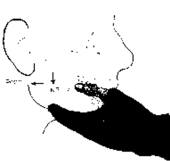 <p>- Patient will require sedation</p><p>- Reduction achieved by placing thumbs overtop occlusal surface of teeth and pulling downward on the mandible then guiding posteriorly and superiorly back into temporal fossae</p><p>DO NOT attempt to reduce fractured mandibles</p>