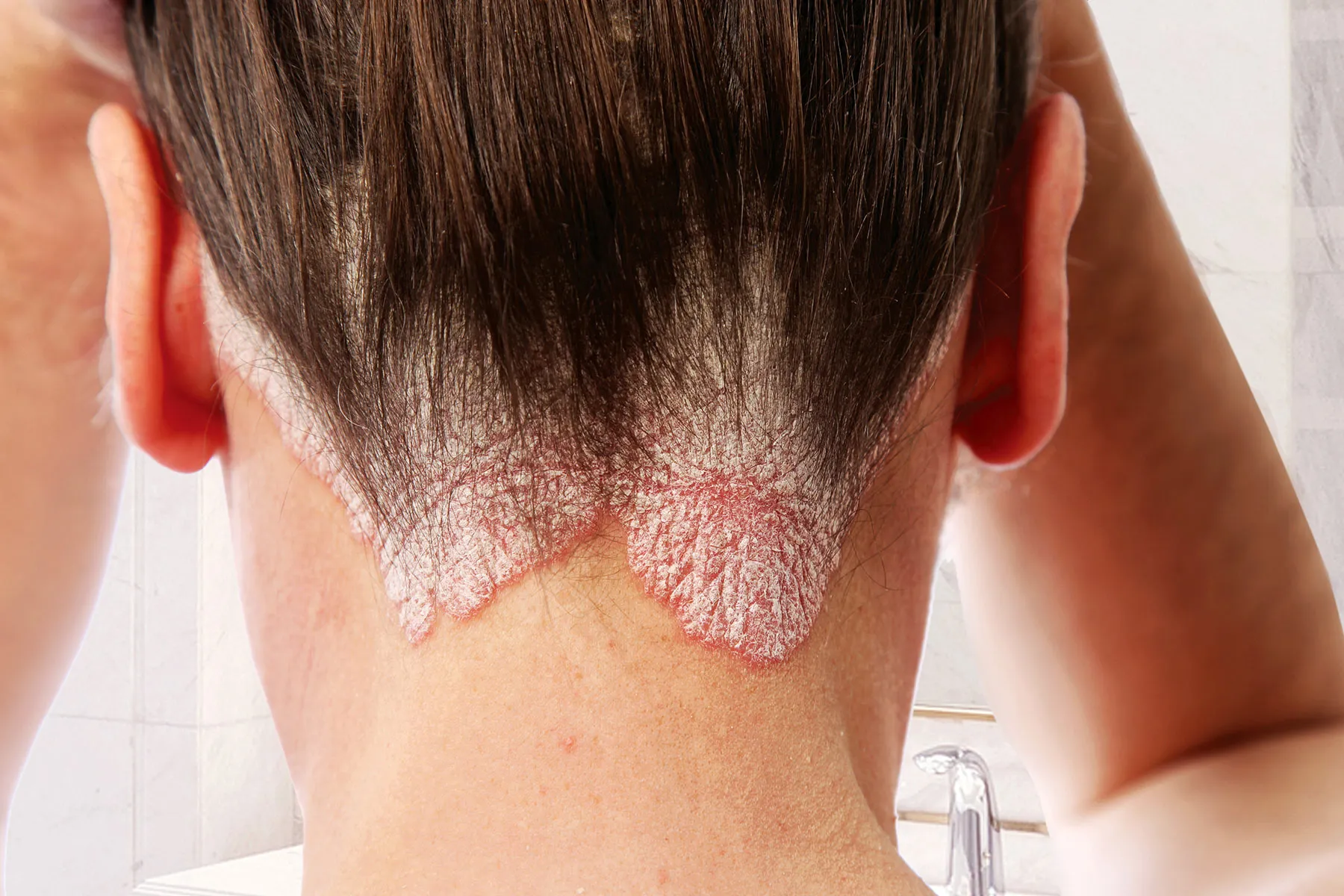 <p>Chronic persistent, relapsing, scaling skin condition, red plaques with silvery scales</p>