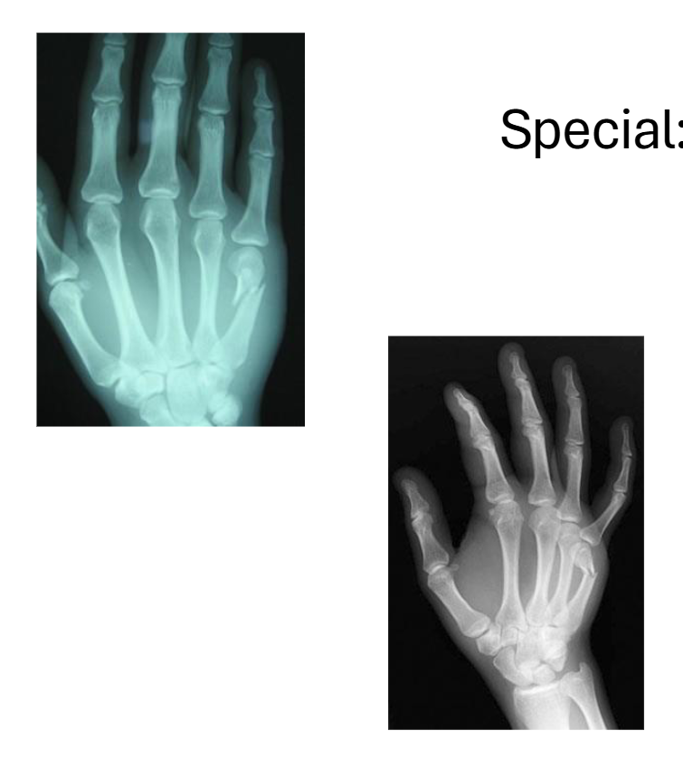 <p>Special: Boxer’s Fracture</p>