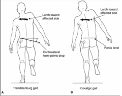 <p>trunk lurch toward affected side (shortens MA of hip abductors so they have to work less, producing less torque on hip), also called compensated Trendelenburg.</p>