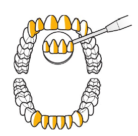 <ul><li><p>Tooth in yellow are anterior surfaces (Towards the clinician) </p></li><li><p><strong>Clinician sit: </strong>Clock position for anterior surfaces is 3 to 4 o’clock</p></li></ul><p></p>